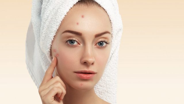Closeup Young Woman With Towel Head Pimples Face