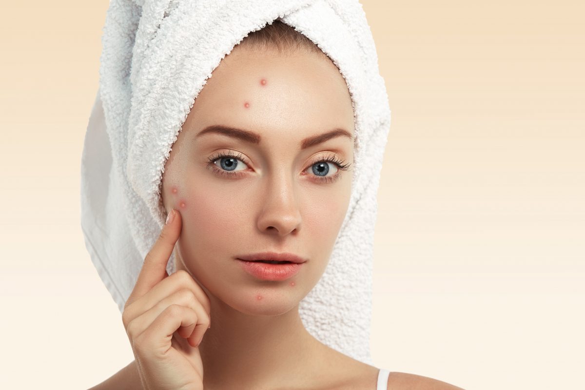 Closeup Young Woman With Towel Head Pimples Face