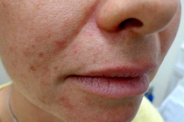 Perioralis Dermatitis (002)