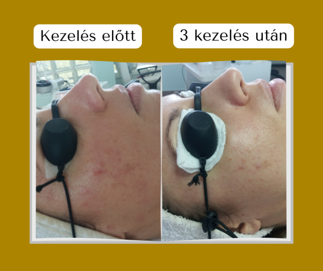 Csillag Mónika Előtte Utána