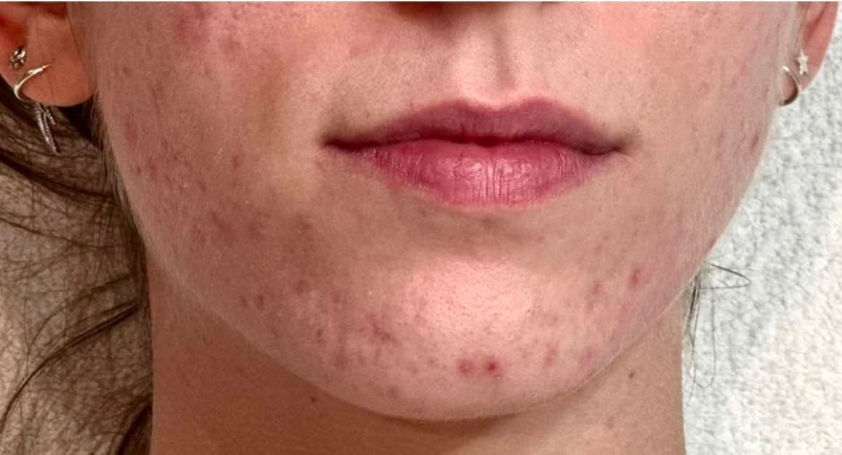 Hormonprobléma (002)