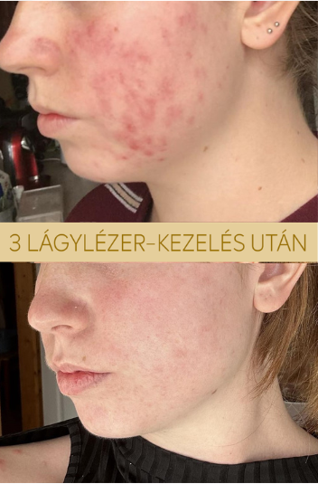 Zsófi Előtte Utána
