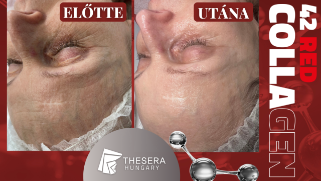 Thesera 42 Red Collagen Eredménykép1